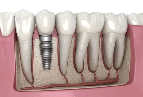 Dental Implants Overview: Key Facts and Important Details